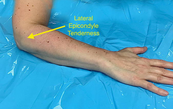 TENNIS ELBOW (LATERAL EPICONDYLITIS) | Hand Surgery Source